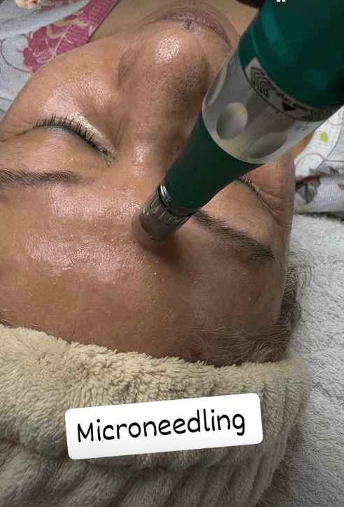 Tratamiento de microneedling en el rostro durante una sesión en cabina