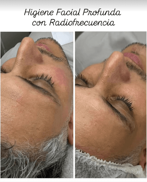 Primer plano del rostro durante un tratamiento facial