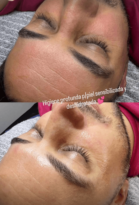 Higiene profunda facial para piel sensibilizada y deshidratada