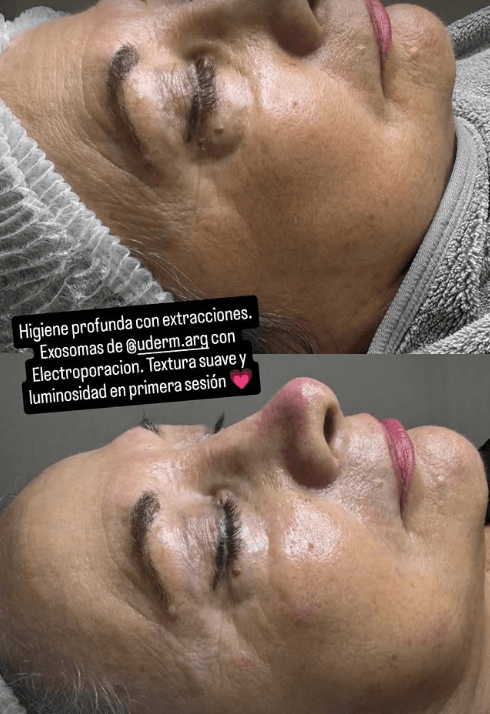 Higiene profunda facial con extracciones, exosomas y electroporación